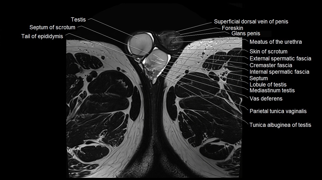 MRI 3T scrotum and penis axial cross sectional anatomy image 34.webp